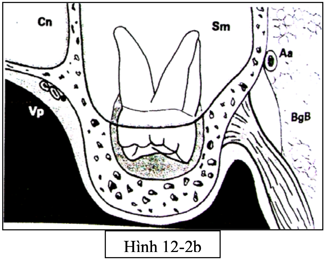 Tiểu phẫu răng khôn hàm trên